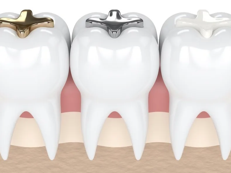 Dental Fillings