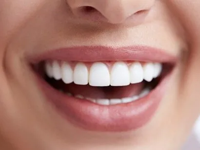 Veneers